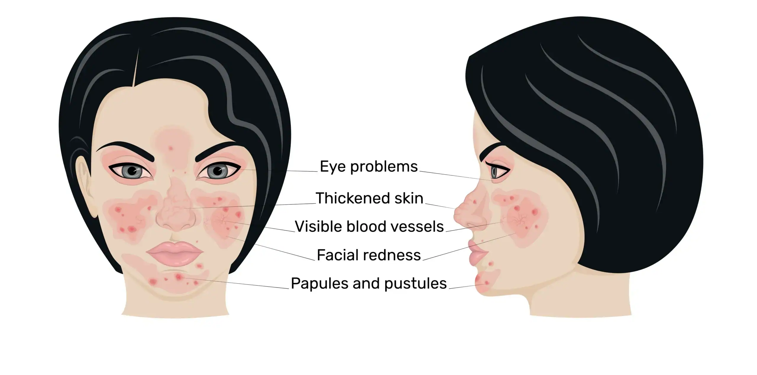 graphic showing common rosacea symptoms on a woman's face