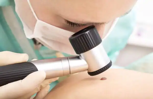 Dermatologist examining a mole on a patient's skin.