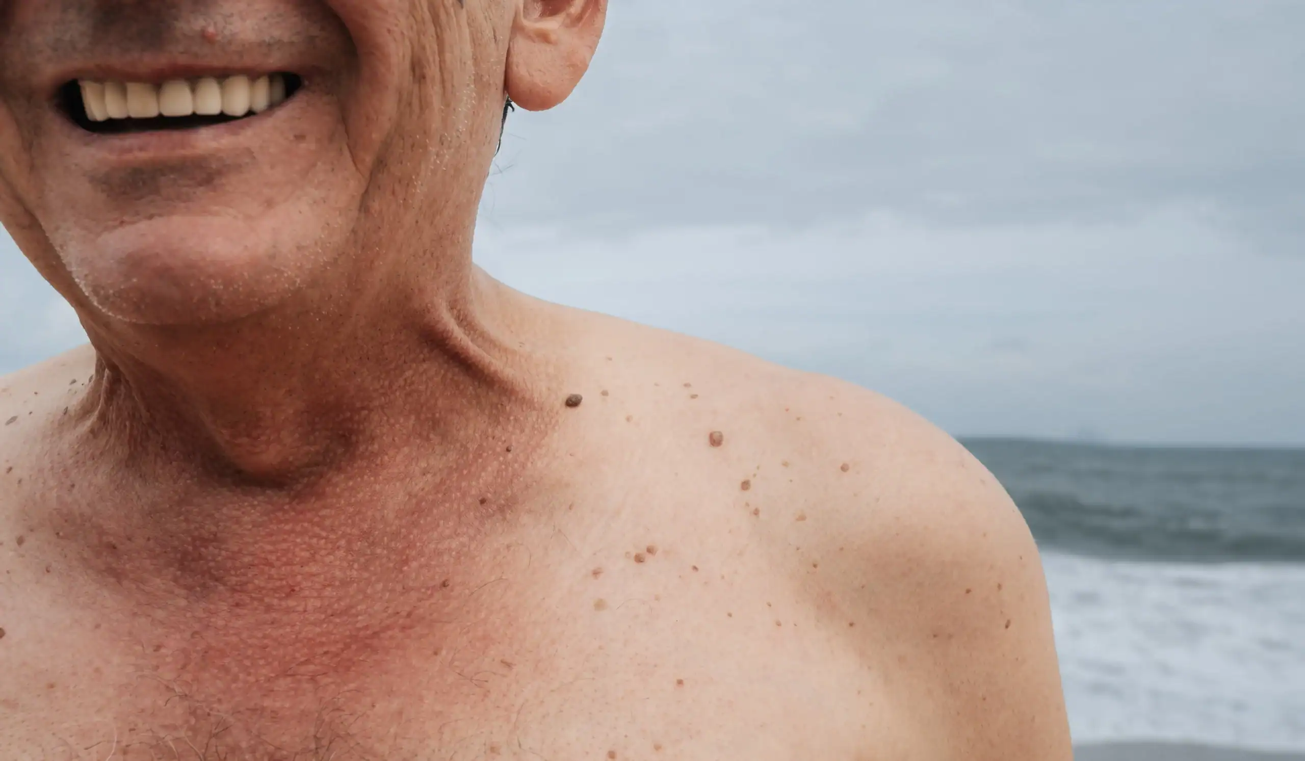 Older man at the beach with moles, freckles and skin growths. Those prone to skin cancer should check their skin regularly