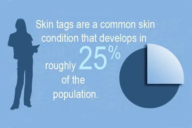 Infographic about how skin tags are a common skin condition that develops in roughly 25% of the population