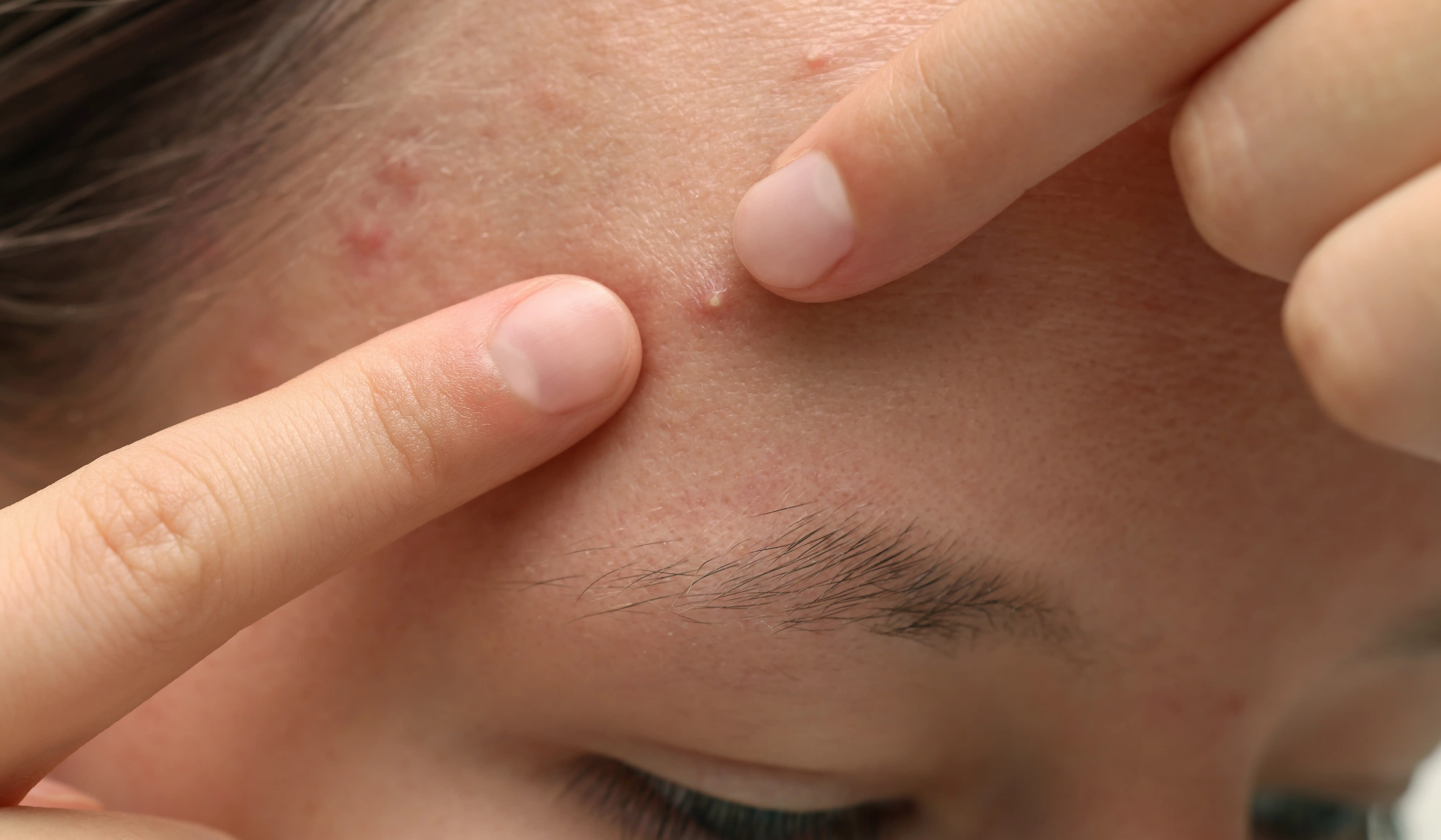 Stopping habits like picking at your acne can stop acne in its tracks