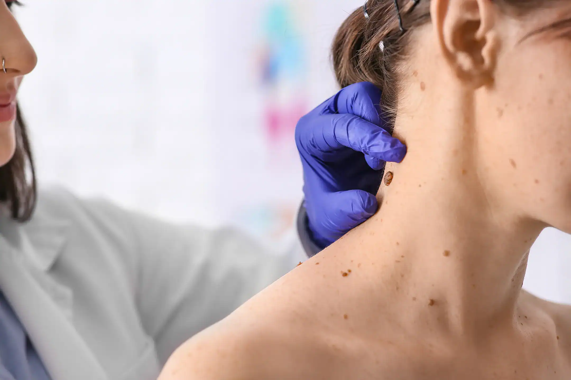 Dermatologist checks our suspicious moles on a female patient's neck