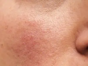 rosacea