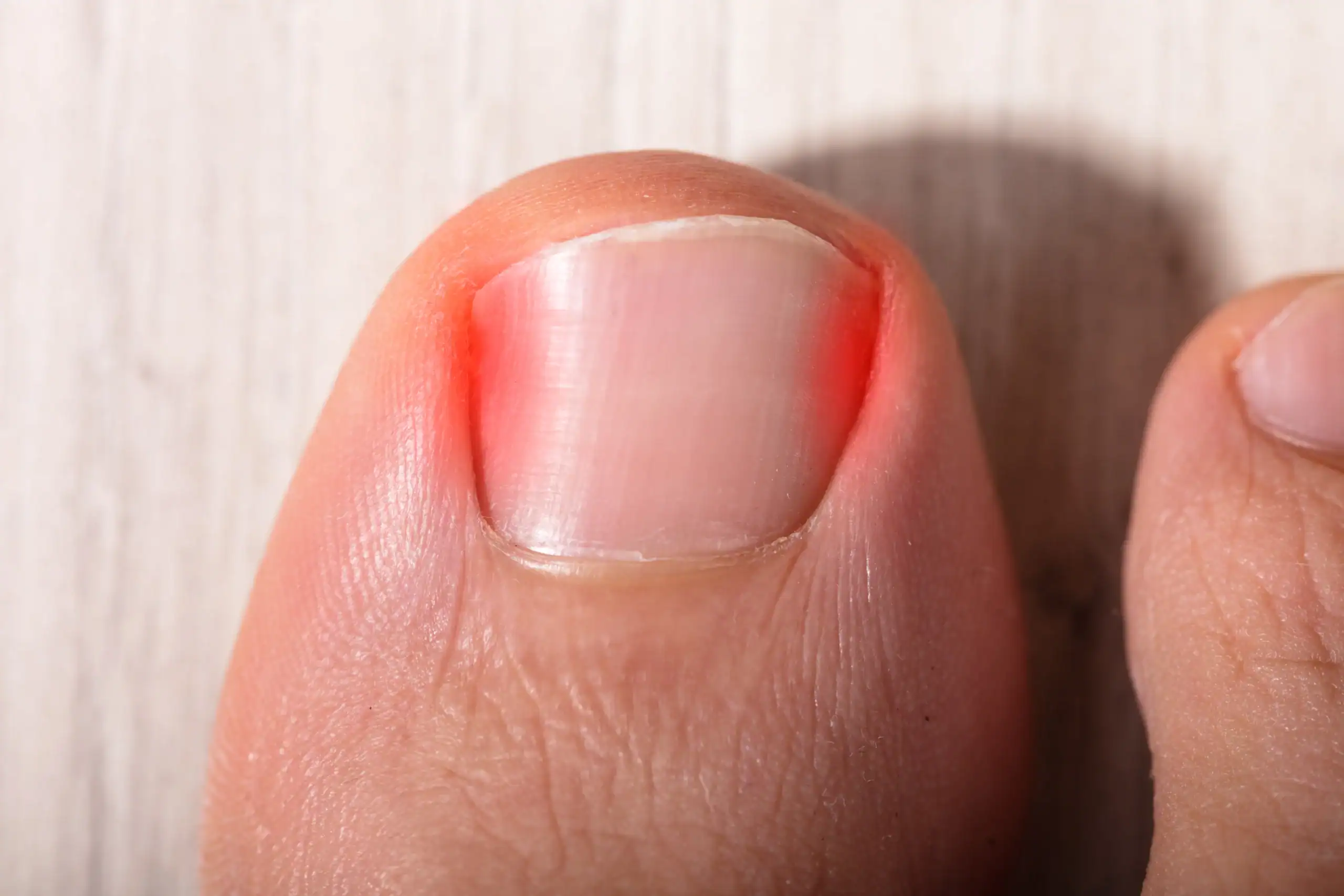 Painful toenail with nail problem