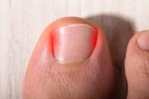 Nail Problem Image