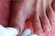 Athlete's Foot Treatment - Foot Fungus - FL Dermatologists - Athlete's Foot - dermatologists near me