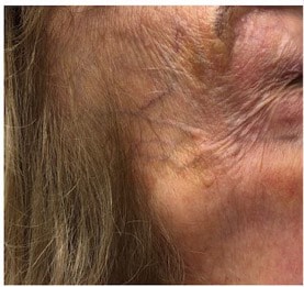 Forehead Veins treatment - vein center - vein doctors near me - Water's Edge Dermatology