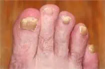 Nail Fungus - Nail Health - Common Nail Disorders - FL Dermatologists - Water's Edge Dermatology