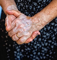 Face veins - Hand Veins - FL Vein Specialists - Water's Edge Dermatology - vein doctor near me - hand vein treatment - vascular surgeon - Dr. Ronald Bush