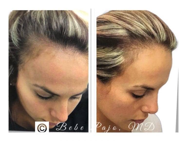 PRP Treatments for Hair Loss | Water's Edge Dermatology | Skin Doctors PRP Treatments for Hair Loss | Water's Edge Dermatology | Skin Doctors