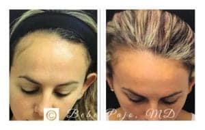 prp for hair loss