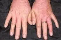 Allergic Contact Dermatitis Treatment - Water's Edge Dermatology - dermatologists near me