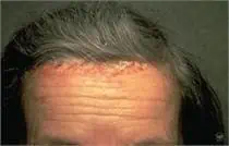 Psoriasis Symptoms - Psoriasis Treatment - Water's Edge Dermatology - FL Dermatologists