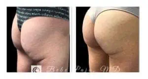 Sculptra Butt Lift - Buttocks Enhancement - Water's Edge Dermatology - Butt Lift near me