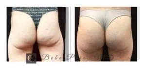 Sculptra Butt Lift - Buttocks Enhancement - Water's Edge Dermatology - Butt Lift near me