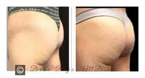 Sculptra Butt Lift - Buttocks Enhancement - Water's Edge Dermatology - Butt Lift near me