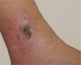 Leg Ulcer treatment - Water's Edge Dermatology - vein doctor near me - vein specialist - vein center