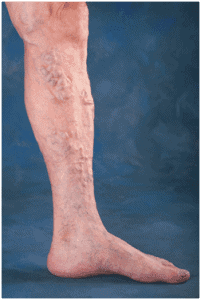 Water's Edge Dermatology - skin doctors - vascular doctors near me - Varicose Veins treatment near me - Spider Veins Treatment near me - FL Dermatologists - dermatologist near me