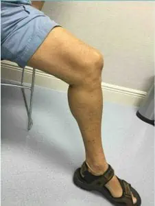 Varicose vein treatment before after photos