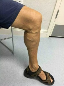 Varicose vein treatment before photos