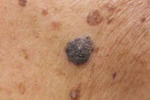 Types of Moles - Mole Treatment - Water's Edge Dermatology - dermatologists near me - dermatologists florida
