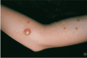 Impetigo Treatment near me - Types of Impetigo - Skin Doctors in Florida - Impetigo - Impetigo causes - Water's Edge Dermatology