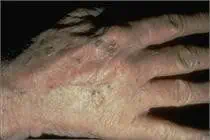 keratosis types - solar keratosis - Actinic Keratosis Treatment near me - Water's Edge Dermatology - FL Dermatologists - Dermatologists near me