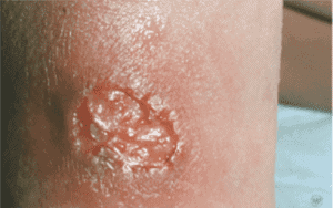 Impetigo Treatment near me - Types of Impetigo - Skin Doctors in Florida - Impetigo - Impetigo causes - Water's Edge Dermatology
