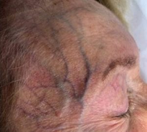 Forehead Veins treatment - vein center - vein doctors near me - Water's Edge Dermatology