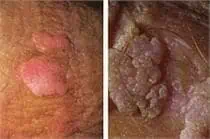 Genital Warts Treatment near me - Water's Edge Dermatology - FL Dermatologists