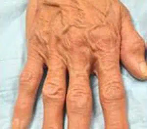 Hand Veins treatment - vein center - vein doctors near me - Water's Edge Dermatology