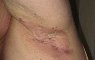 Hidradenitis Suppurativa Treatment near me - Water's Edge Dermatology - FL Dermatologists - Dermatologists near me
