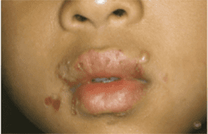 Impetigo Treatment near me - Types of Impetigo - Skin Doctors in Florida - Impetigo - Impetigo causes - Water's Edge Dermatology