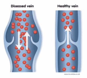 Water's Edge Dermatology - varicose veins treatment - Veins in Legs - Vein Disease Treatments - Water's Edge Dermatology - vein center near me - vein specialist 