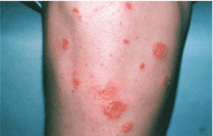 Impetigo Treatment near me - Types of Impetigo - Skin Doctors in Florida - Impetigo - Impetigo causes - Water's Edge Dermatology