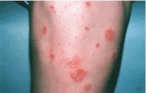 Impetigo Treatment near me - Types of Impetigo - Skin Doctors in Florida - Impetigo - Impetigo causes - Water's Edge Dermatology