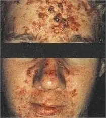 Acne Treatment - Acne Scar Removal - FL Dermatologists - Water's Edge Dermatology - Dermatologist near me