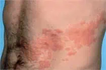 Shingles Treatment near me - Water's Edge Dermatology - FL Dermatologists - shingles on face - internal shingles