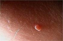 Skin Tag Removal - Skin Tag Treatment - Water's Edge Dermatology - FL Dermatologists