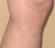 Spider vein treatment after photos