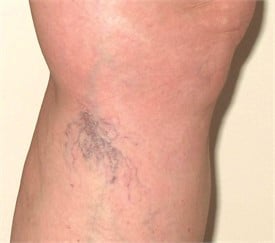 Spider vein treatment before photo