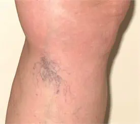 Spider vein treatment before photo