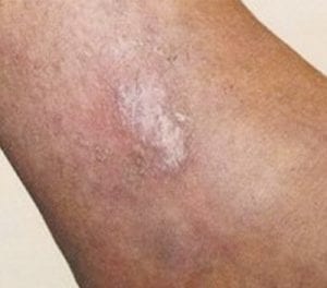 Venous ulcer treatment before after photos