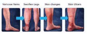 Water's Edge Dermatology - varicose veins treatment - Veins in Legs - Vein Disease Treatments - Water's Edge Dermatology - vein center near me - vein specialist 