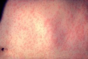 <img src="Morbillivirus.jpg" alt="Morbillivirus measles treatment"/> 