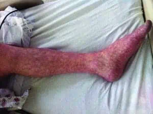 <img src="legrash.jpg" alt="Livedo reticularis treatment"/> 