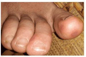 <img src="toe.jpg" alt="Acute Acro Ischemia treatment"/> 