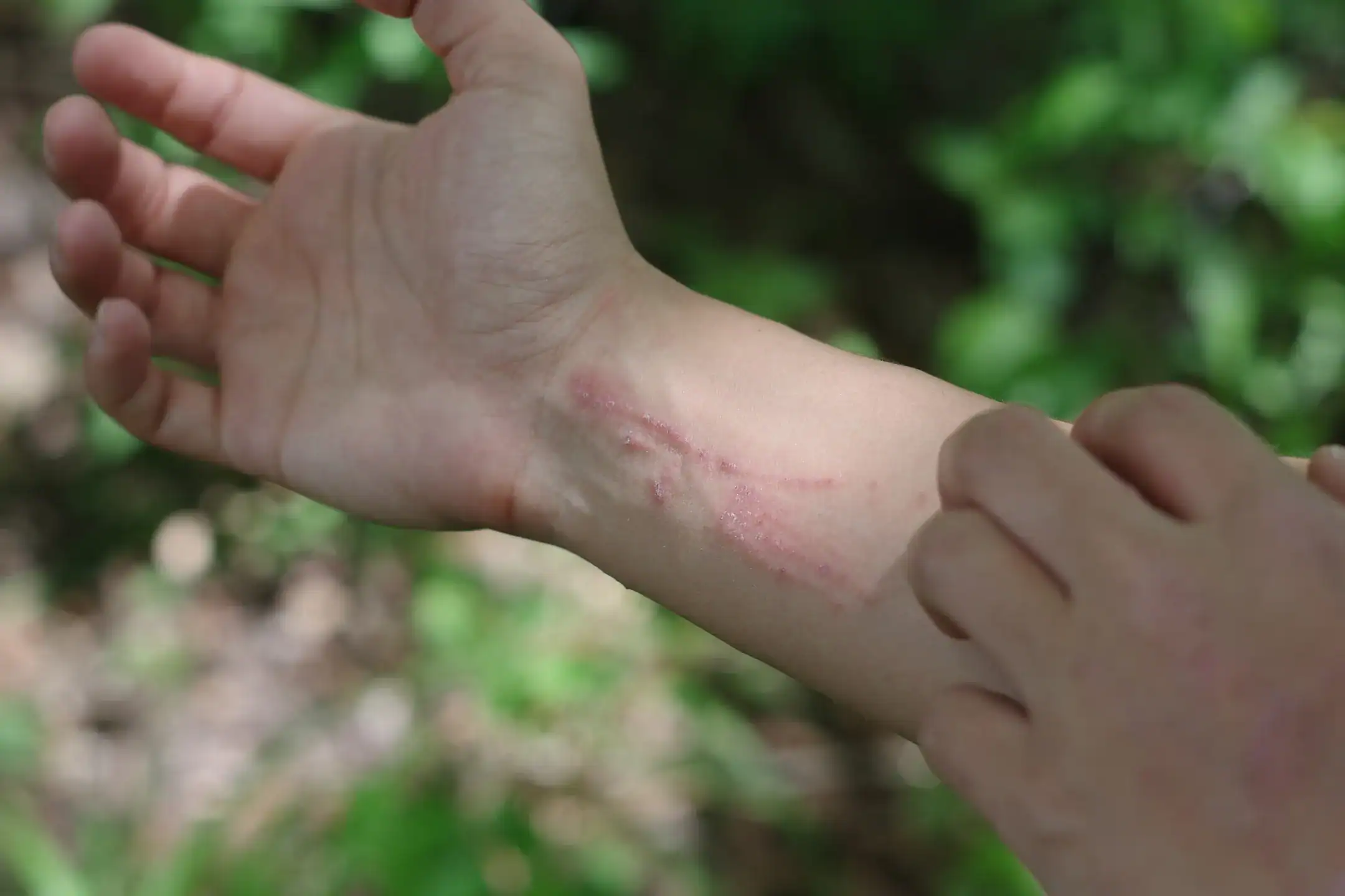 Fingers scratch a poison ivy rash on an open forearm in the woods
