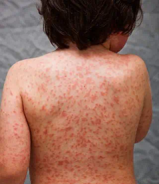 Kawasaki skin rash on child’s back, PMIS