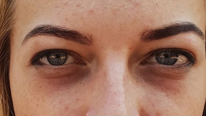 How To Reduce and Prevent Under Eye Lines and Bags